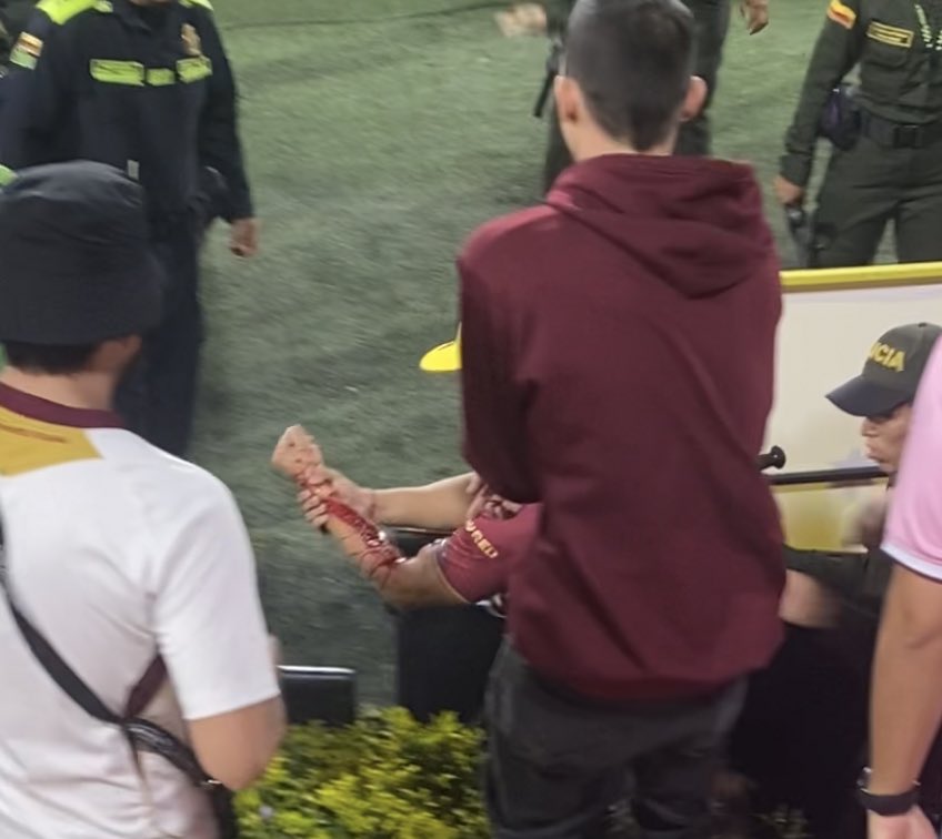 Así le quedó el brazo al hincha del Tolima tras la agresión sufrida.