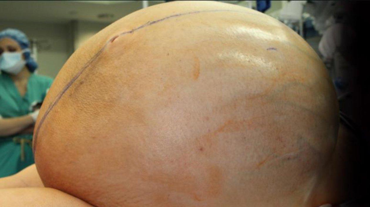 La cirugía, realizada a comienzos de este año, fue un éxito y el equipo médico extrajo el tumor al mismo tiempo que reconstruyó la piel de su abdomen.