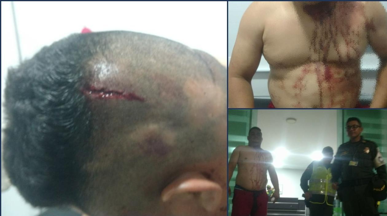 Dixon González, expatrullero de la Policía, muestra sus heridas.