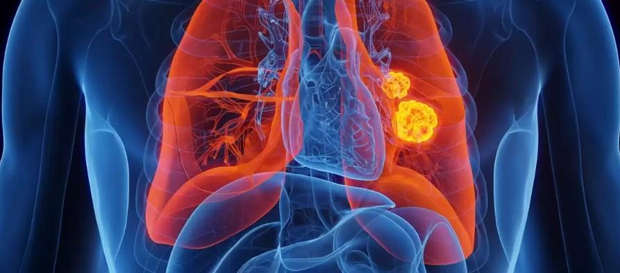 El cáncer de pulmón es la primera causa de muerte por cáncer a nivel mundial