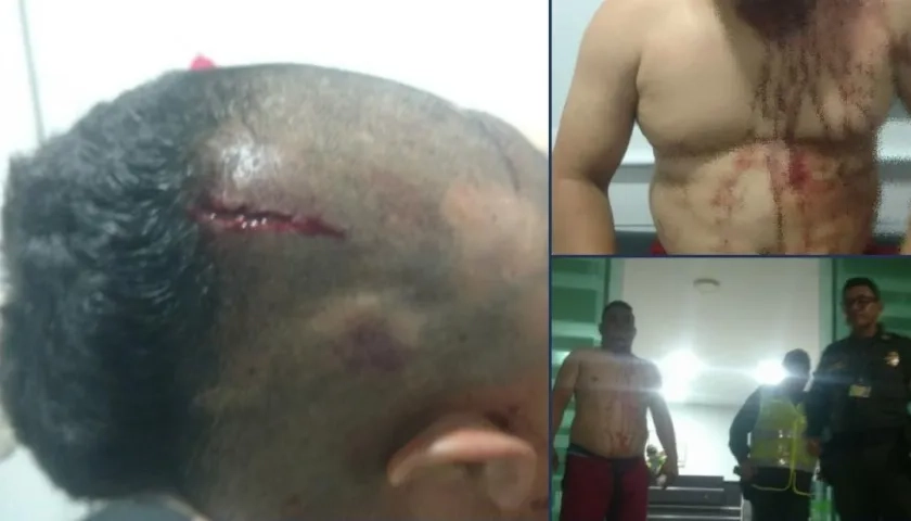 Dixon González, expatrullero de la Policía, muestra sus heridas.