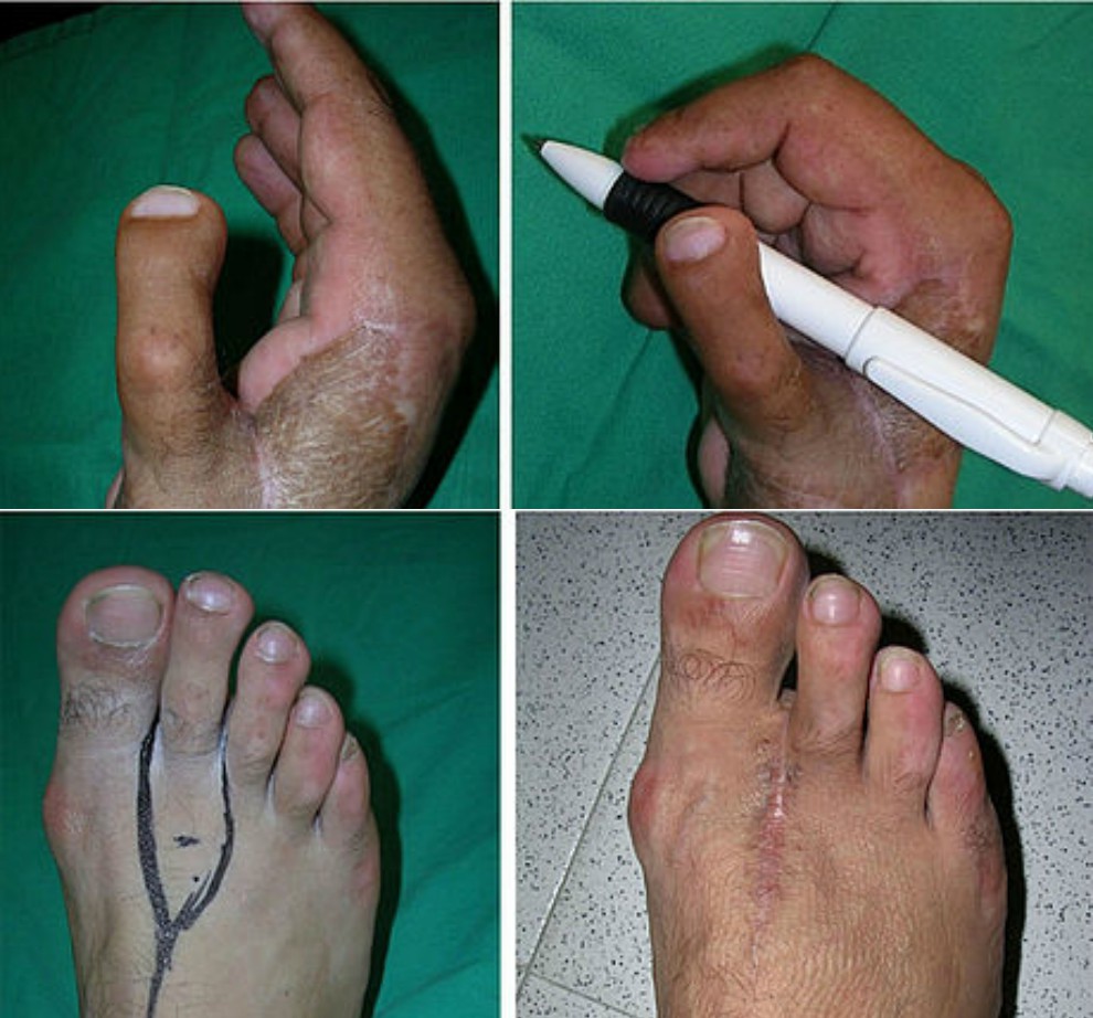 Cómo es el trasplante del dedo del pie a la mano en casos de amputaciones?