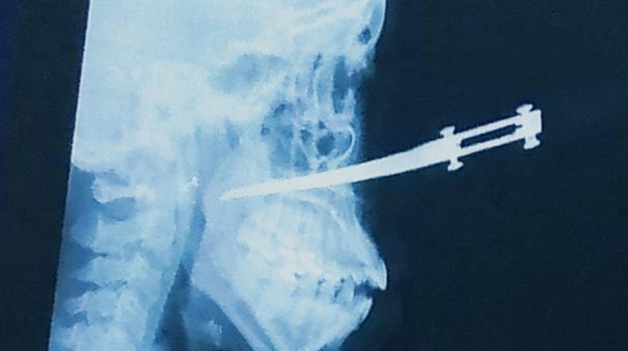 Radiografía de cómo le quedó enterrado el cuchillo en el rostro de la mujer. 