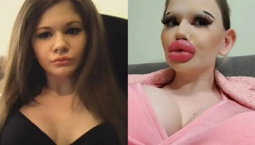Andrea Ivanova en una foto de antes y después de los procedimientos para engrosar sus labios.