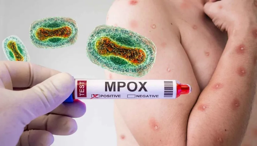 Mpox. 