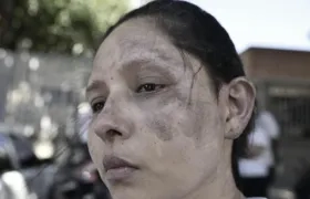 Vilma recibió quemaduras en parte de su rostro. 