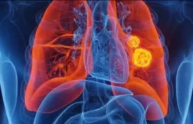 El cáncer de pulmón es la primera causa de muerte por cáncer a nivel mundial 