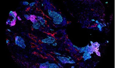 Imagen cedida de células tumorales de cáncer de pulmón